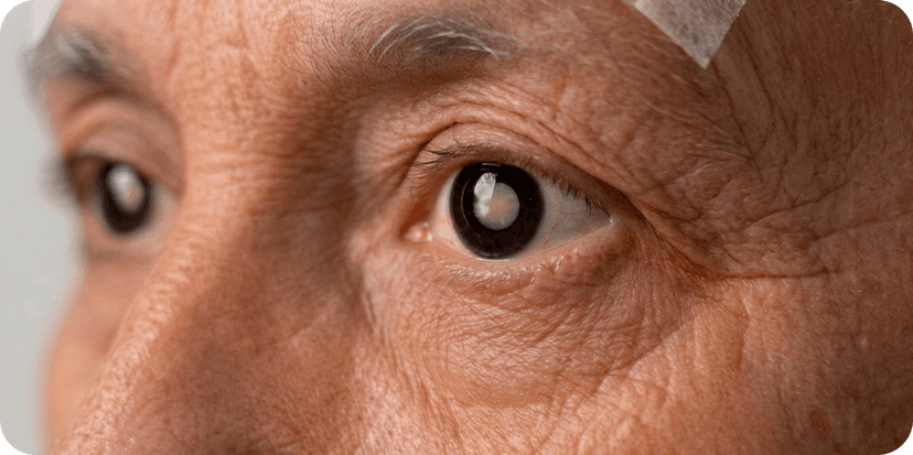 Close view of an eye with cataract