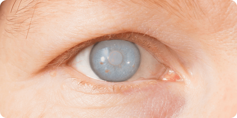 Close view of an eye for glaucoma care