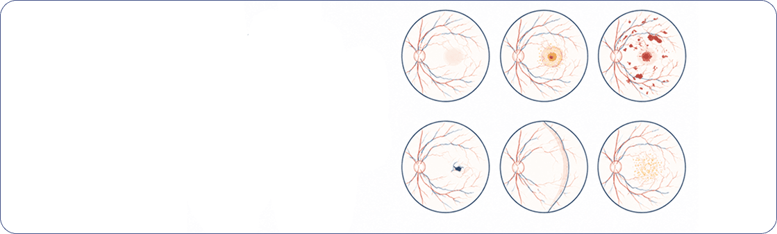 Eye drops being applied during retina care