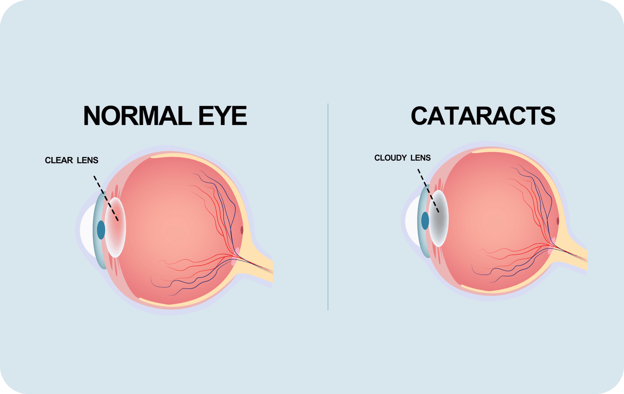 Normal eye and cataract lens comparison