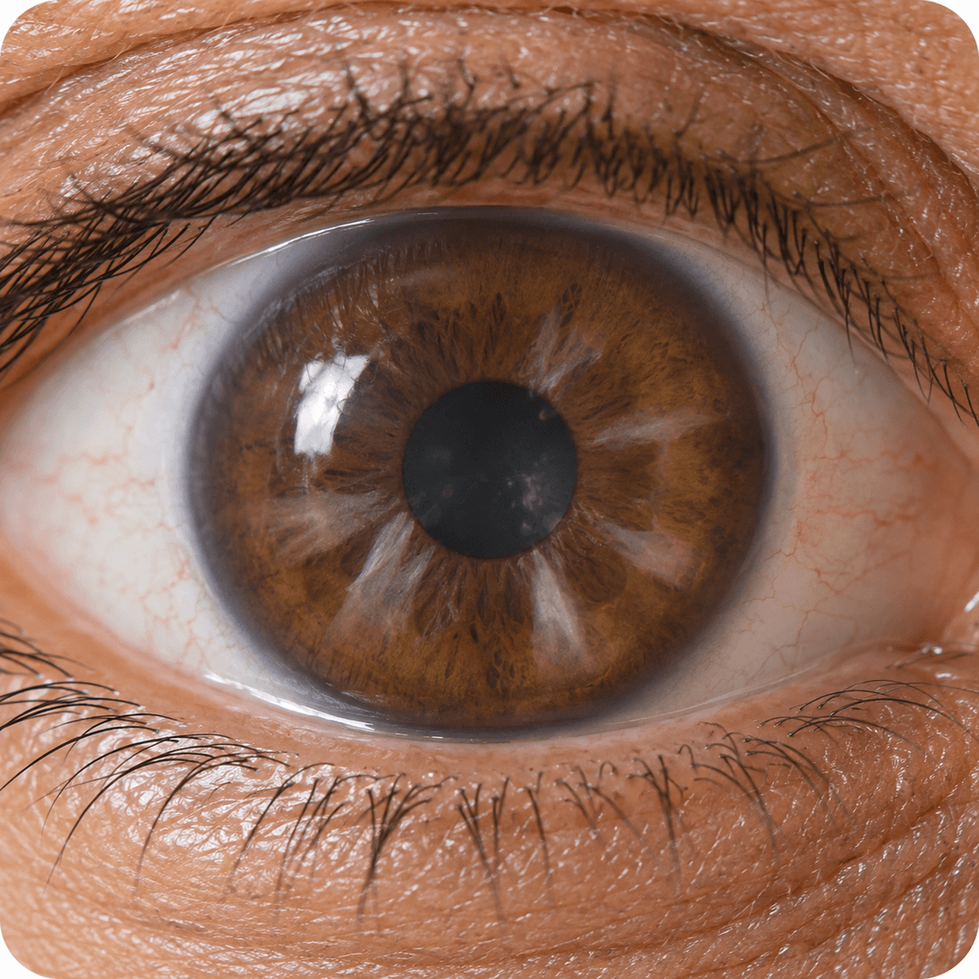 Cortical cataract eye