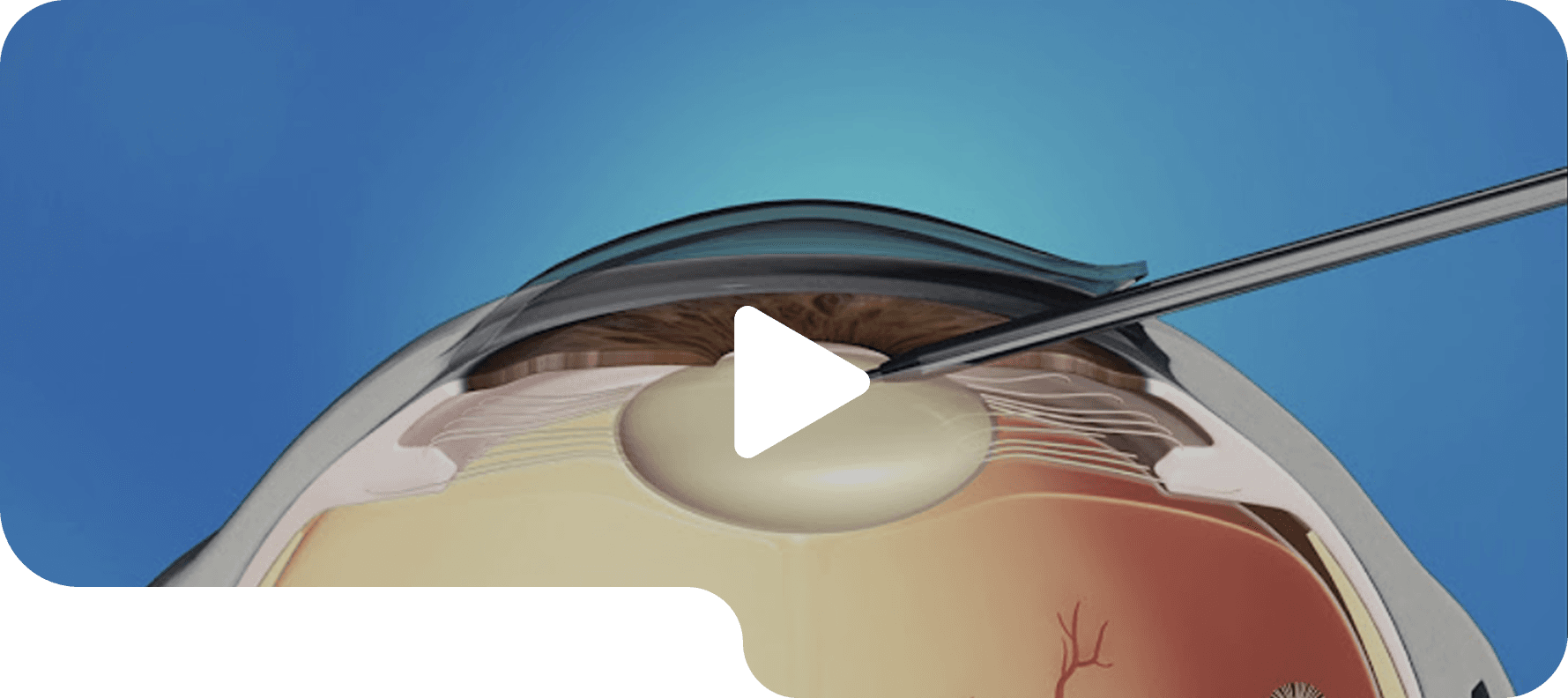 Meibomian gland evaluation