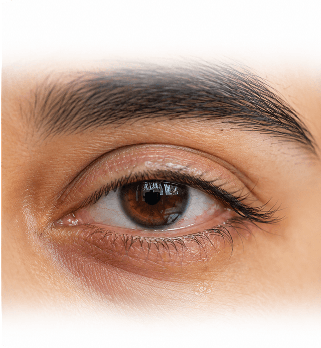 Evaporative Dry Eye