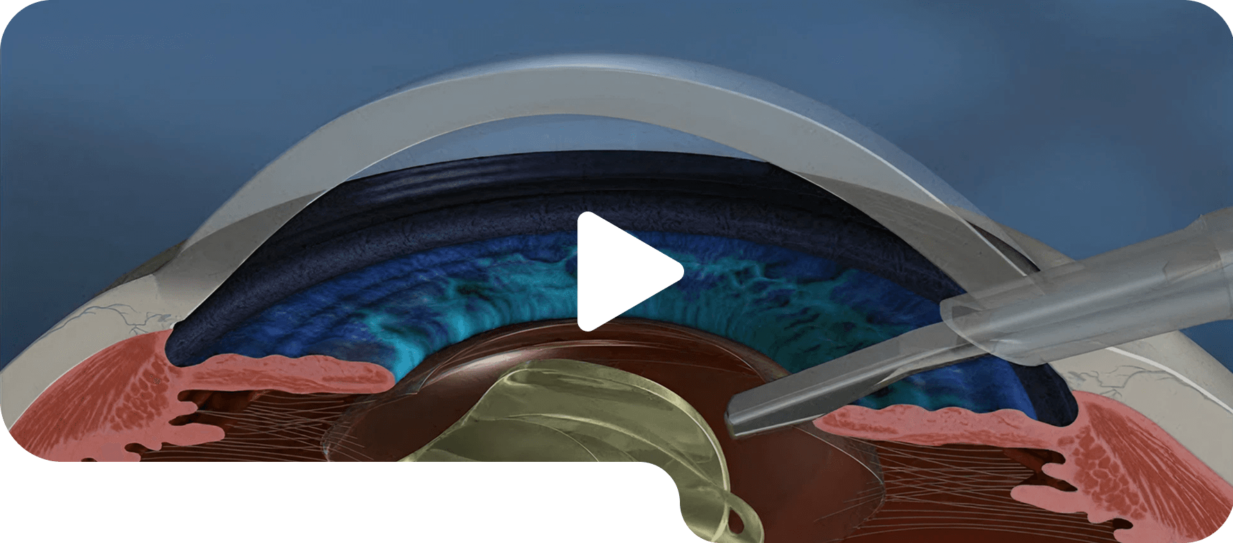 Optic Nerve Evaluation