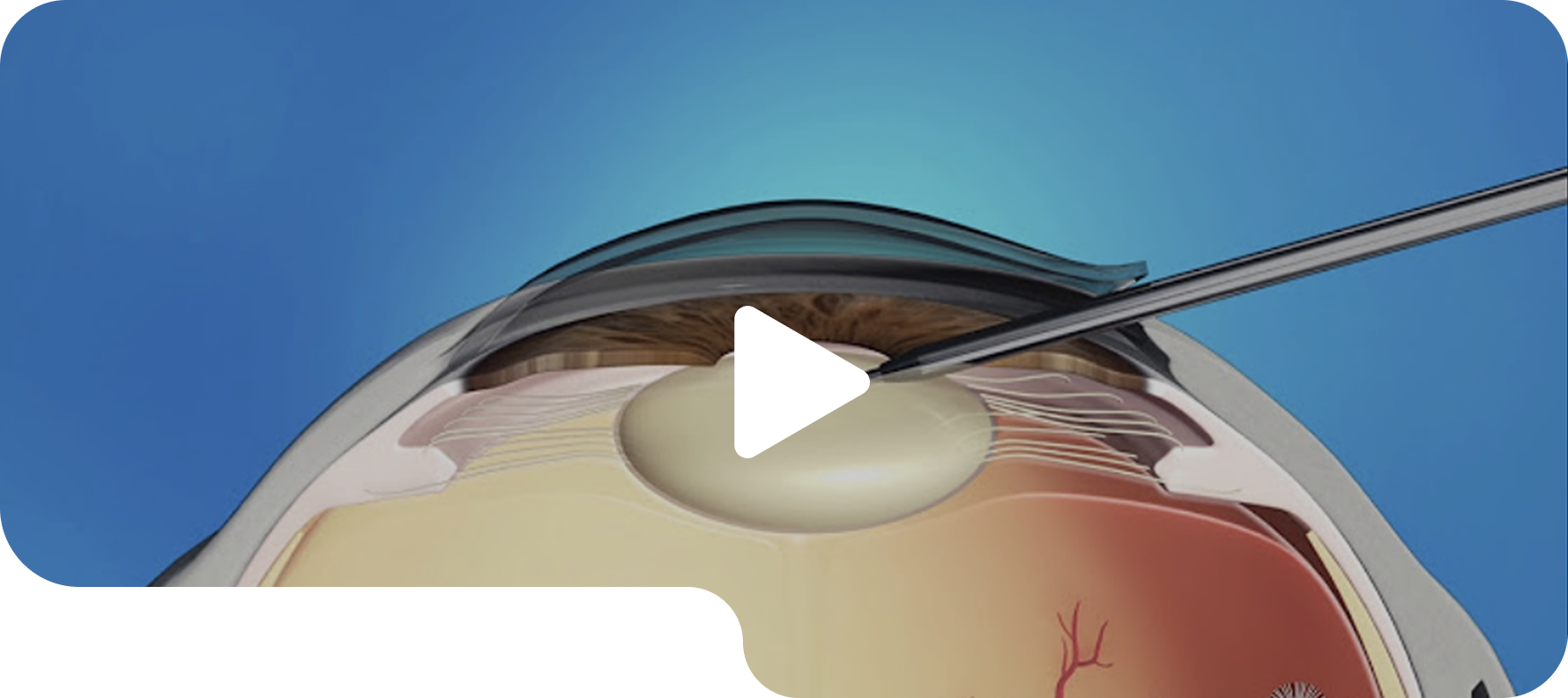 Phacoemulsification cataract surgery