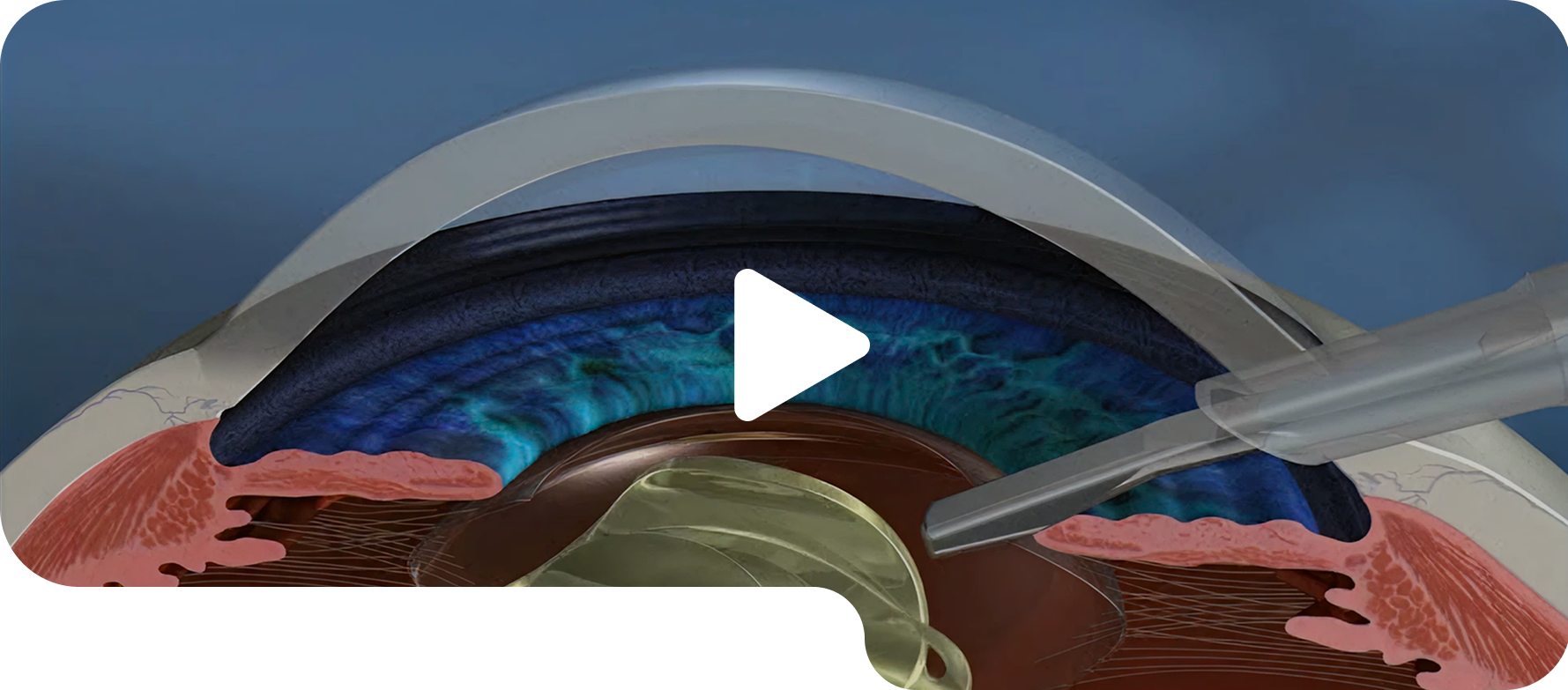 Laser cataract surgery