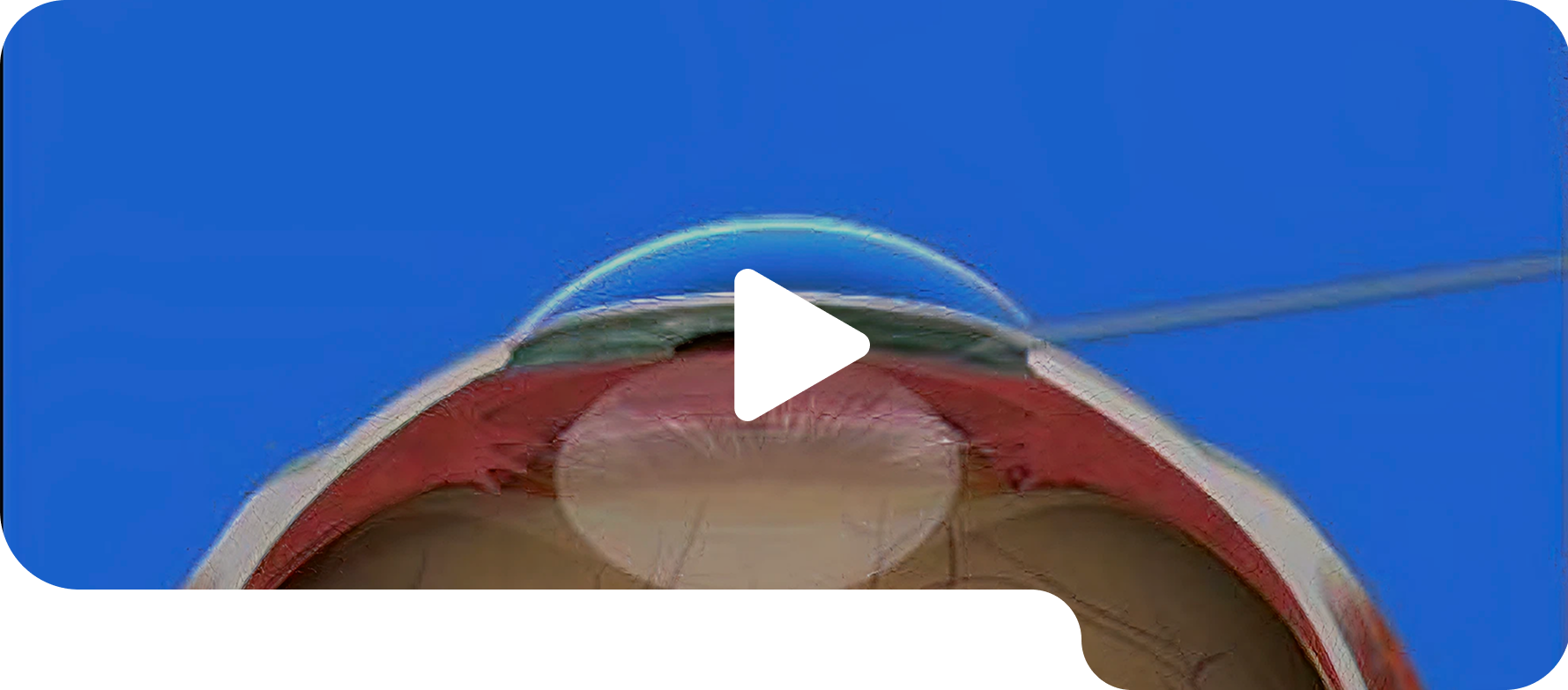 Micro incision cataract surgery